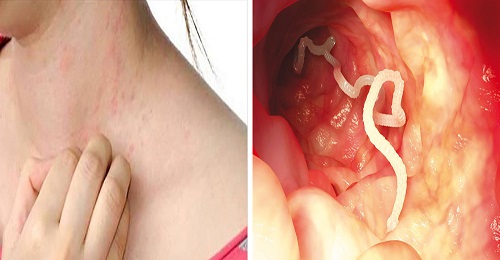 10 Symptoms You Have Parasites In Your Body
