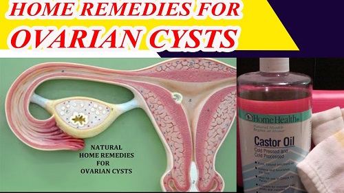 Ovarian Cysts Treatments At Home